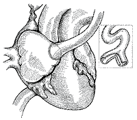 Cardiovascular reconstruction