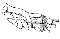Intestinal anastomosis